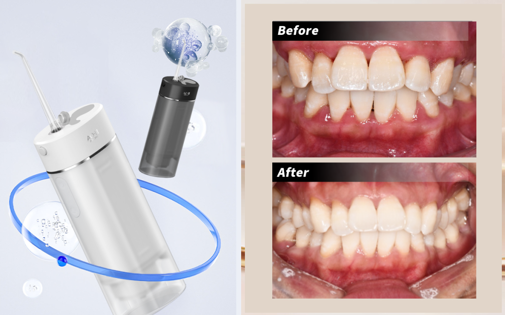 banish bacteria, soothe gums, restore health ozone water flossing